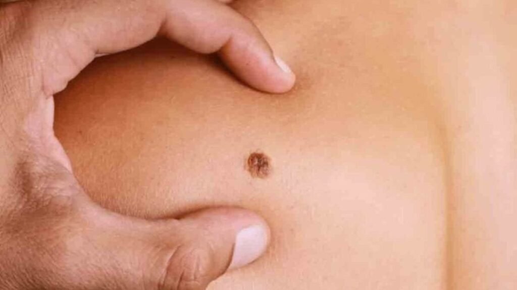 Salud Pública llama a detectar a tiempo el sarcoma y destaca la importancia del diagnóstico temprano